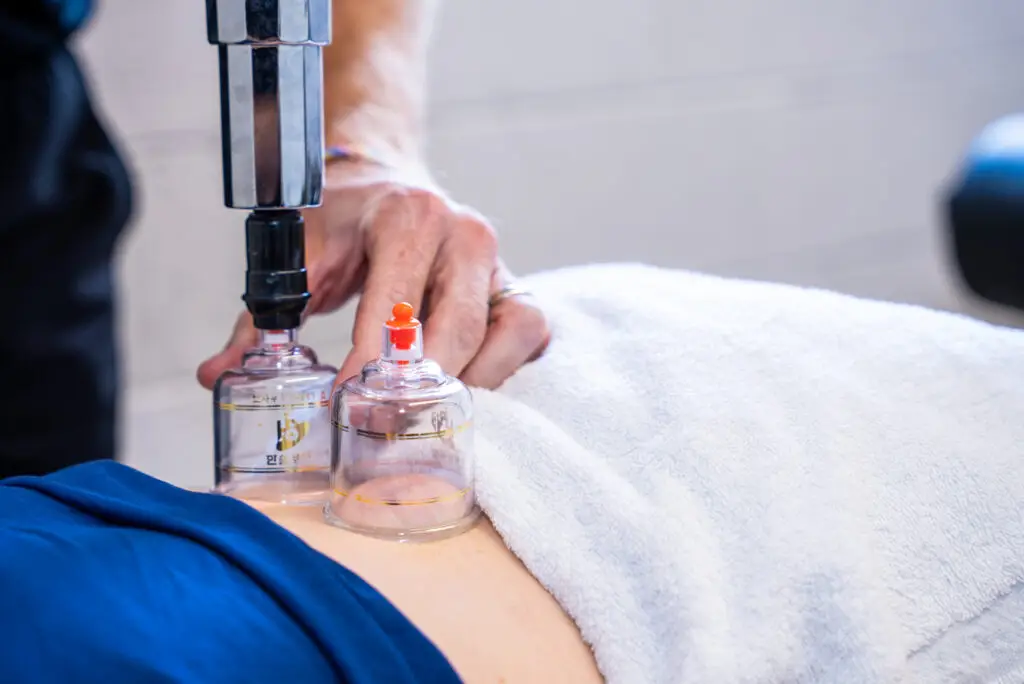 cupping therapy - core physical therapy